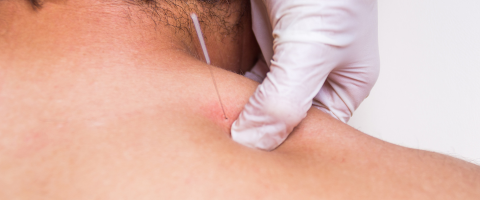 Dry Needling